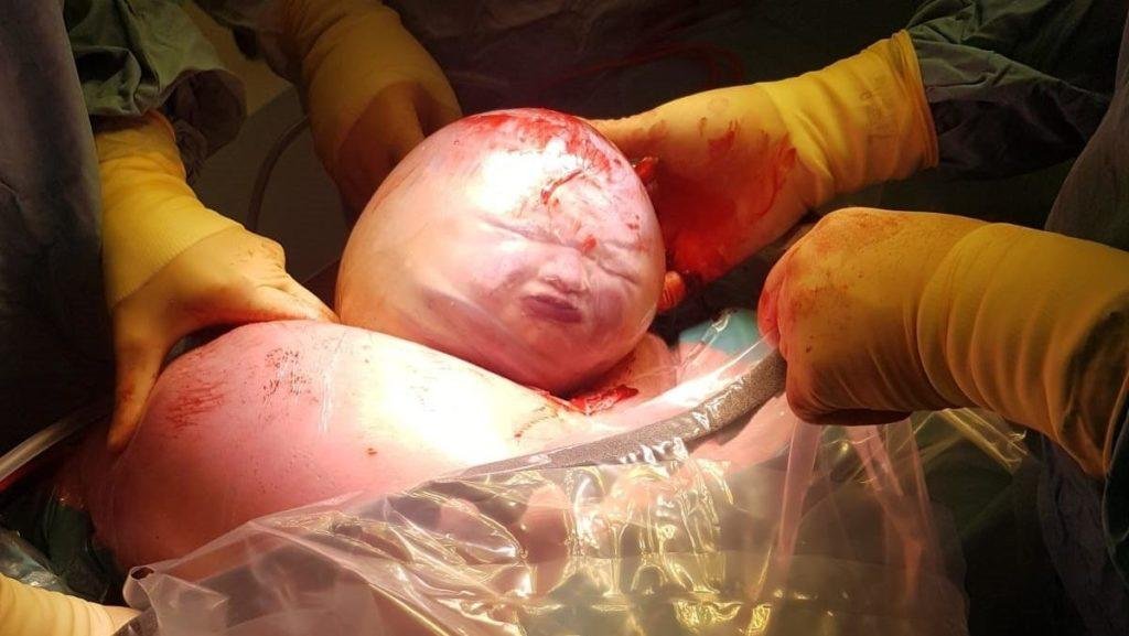 Baby In Fruchtblase Geboren