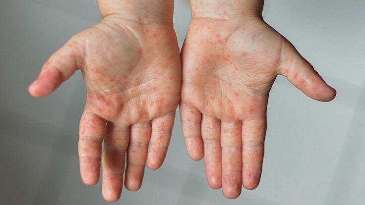 Hand Mund FuÃŸ Krankheit Immun